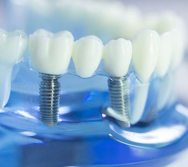Richmond Dental Implants